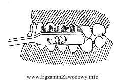 Przedstawiona na rysunku metoda oczyszczania uzębienia zalecana jest