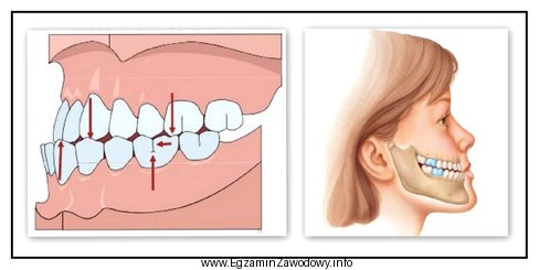 Którą wadę zgryzu przedstawiają rysunki?