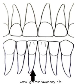 Na rysunku przedstawiającym rzut wargowy zębów przednich 