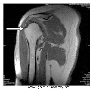 Którą strukturę anatomiczną oznaczono na zamieszczonym obrazie rezonansu magnetycznego?