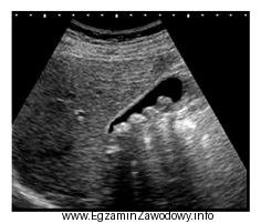 Którą strukturę anatomiczną uwidoczniono na zamieszczonym obrazie USG?