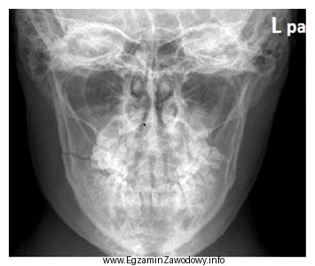 Na radiogramie żuchwy uwidoczniono złamanie w okolicy