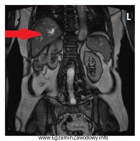 Na obrazie MR jamy brzusznej strzałką wskazano