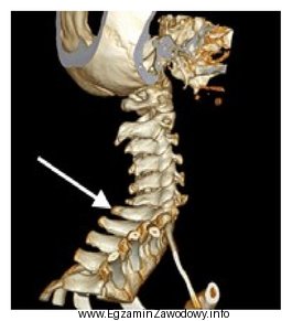 Na obrazie TK kręgosłupa strzałką wskazano wyrostek