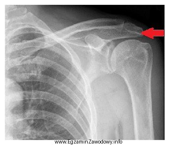 Na radiogramie stawu barkowego strzałką wskazano
