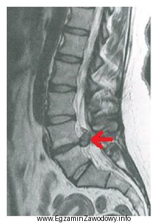 Na obrazie MR kręgosłupa lędźwiowego strzałką 
