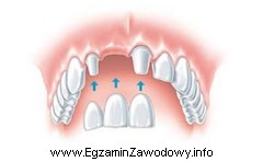 Jaką pracę protetyczną przedstawia rysunek?