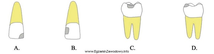 Który rysunek przedstawia ubytek próchnicowy klasy IV?