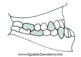 Rysunek przedstawia warunki zgryzowe u pacjenta. Widocznym zaburzeniem zgryzowym jest