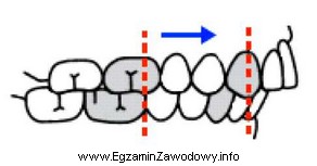 Którą wadę szczękowo-zgryzową przedstawia rysunek?