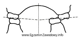 Którą wadę zgryzu przedstawia rysunek?