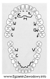 Zamieszczony diagram badania wewnątrzustnego przedstawia