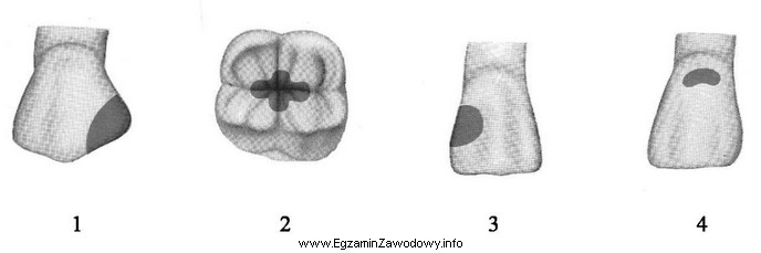 Który rysunek przedstawia ubytek próchnicowy klasy I?