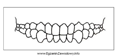 Na rysunku przedstawiono zgryz krzyżowy częściowy