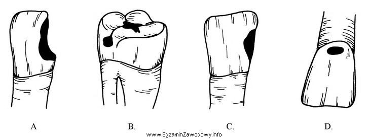 Wskaż ilustrację przedstawiającą czwartą klasę ubytków próchnicowych 