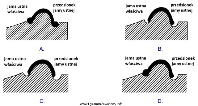 Prawidłowo wykonane obrzeże dolnej łyżki indywidualnej 