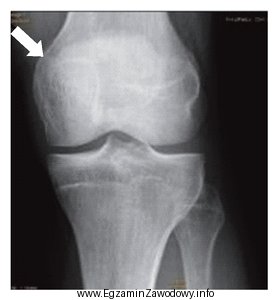 Którą strukturę anatomiczną zaznaczono na radiogramie stawu kolanowego?