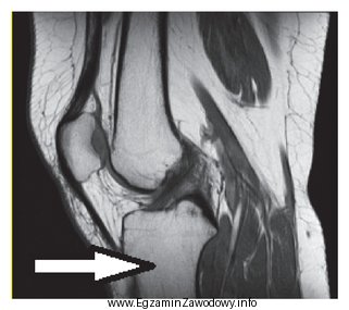 Którą kość oznaczono na obrazie rezonansu magnetycznego?