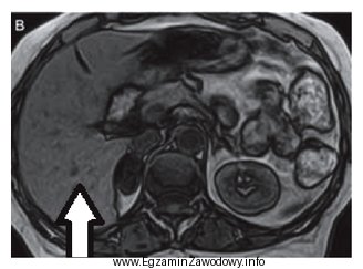 Na przekroju poprzecznym rezonansu magnetycznego strzałką oznaczono