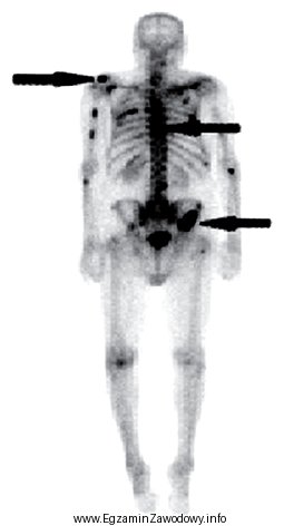 Na scyntygramie kości strzałkami oznaczono ogniska