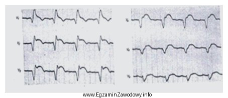 Na elektrokardiogramie zarejestrowano