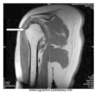 Którą strukturę anatomiczną oznaczono na obrazie rezonansu magnetycznego?