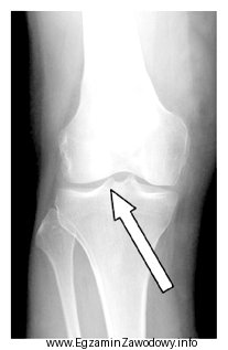 Którą strukturę anatomiczną oznaczono strzałką na radiogramie stawu 