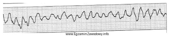 Zamieszczony elektrokardiogram przedstawia