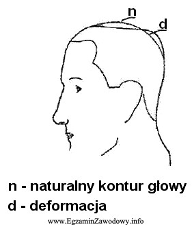 Jaką deformację głowy przedstawiono na rysunku?
